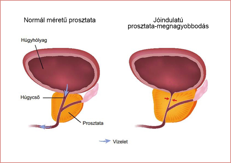 prostatic adenoma pathology outlines